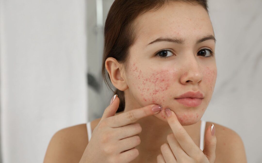 Is a Dermatologist Good for Teen Acne?